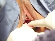 Vaginoplastia