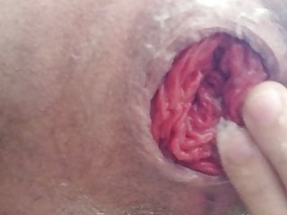 Close up self fisting with anal prolapse 